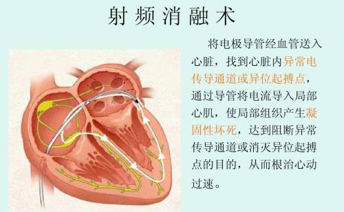 射频消融去眼袋多少钱？射频祛眼袋效果怎样？