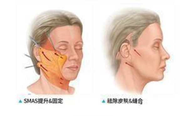 筋膜悬吊适合哪些部位？怎么操作？