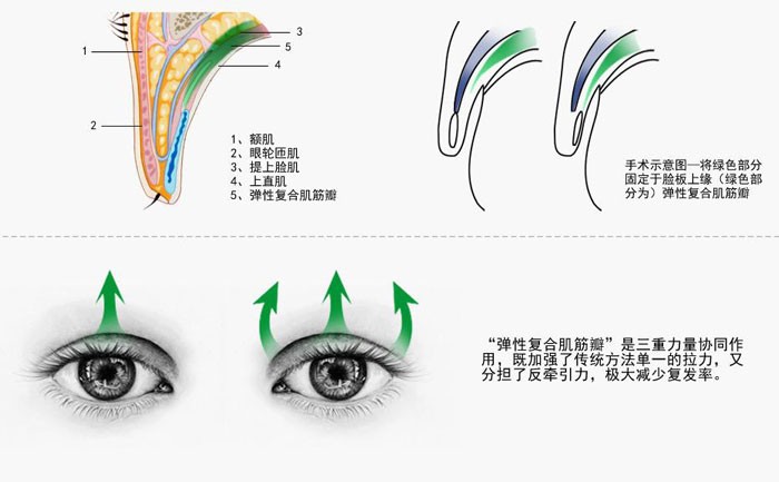 上睑下垂的症状？上睑下垂怎么改善？