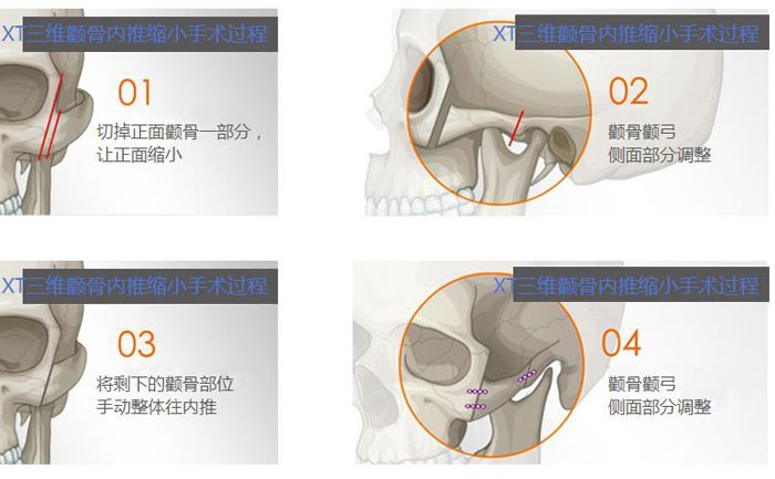 颧骨内推一般多少钱？颧骨内推有副作用吗？