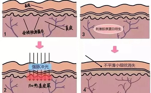 光子嫩肤去除鱼尾纹的步骤是什么？光子嫩肤有什么优势？