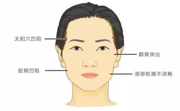 颧骨高或颧骨外扩怎么办呢？新型微创颧骨整形有什么优势？