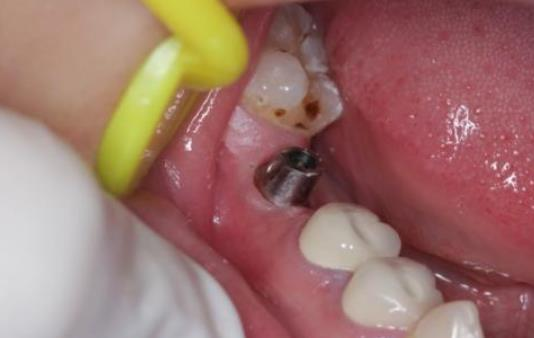 重庆牙卫士口腔崔南种植牙案例分享