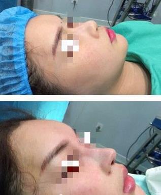 首都医科大学附属北京友谊医院医学美容中心耳软骨隆鼻案例术后即刻对比