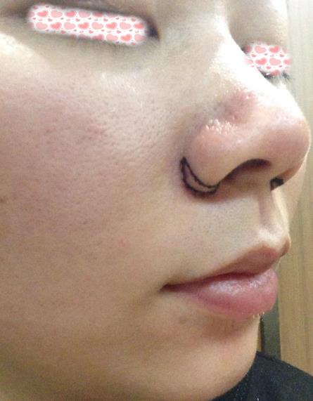 西安米兰柏羽整形手术缩鼻翼案例分享术后一周效果