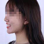 杭州国雅口腔隐形矫正案例分享，有这么好看的牙就要多笑笑