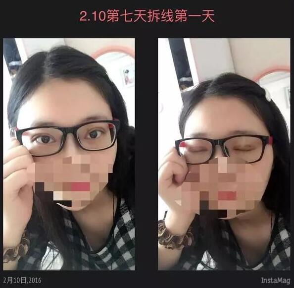 北京京民双眼皮修复案例术后拆线效果