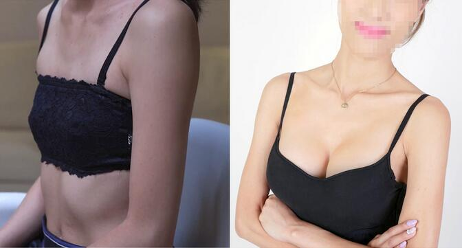 北京东方和谐整形自体脂肪隆胸案例反馈，飞机场女生必看