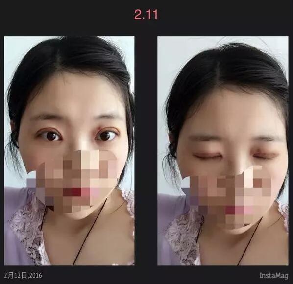 北京京民双眼皮修复案例拆线后第二天