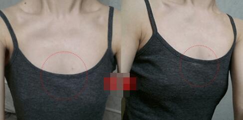 北京东方和谐整形自体脂肪隆胸案例前后对比图