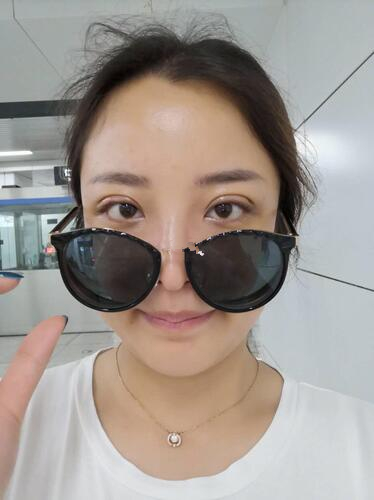济南韩式整形双眼皮案例分享，单看术后半个月效果还以为手术失败了