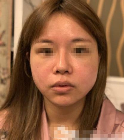 南京阅颜整形瘦脸针案例分享，轻松抗住原相机