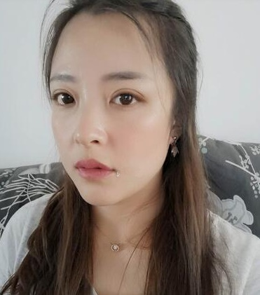 济南韩式整形双眼皮案例分享，单看术后半个月效果还以为手术失败了