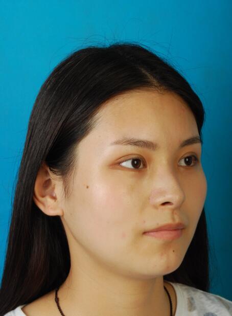 西安国际下颌角整形术后三个月侧面效果