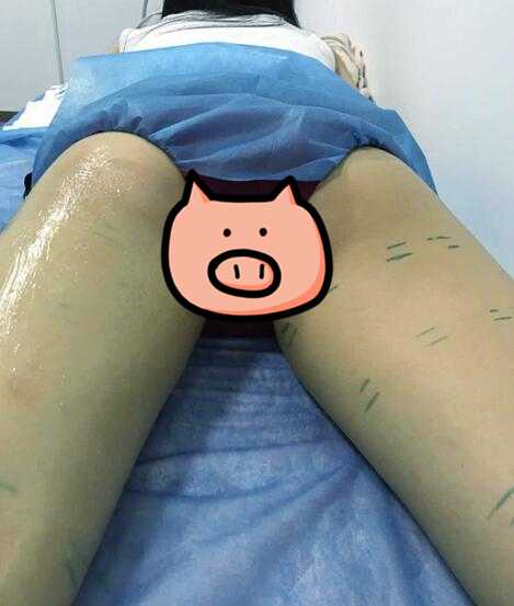 青岛大学医学院附属医院整形美容烧伤科陈振宇双腿吸脂案例分享