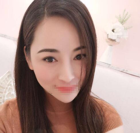赤峰现代妇产医院医疗美容科袁俊龙双眼皮修复术后一个月