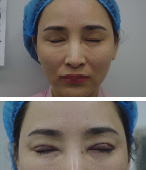 赤峰现代妇产医院医疗美容科袁俊龙双眼皮修复术后即刻