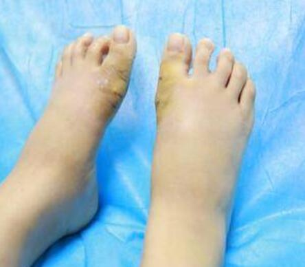 大同和平烧伤骨科医院整形美容科大脚骨矫正案例分享