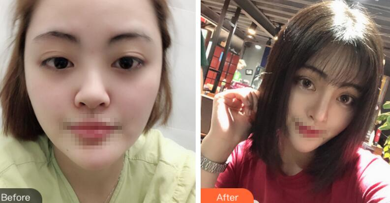 上海赛美瑞整形张化举鼻综合术后两个月效果分享