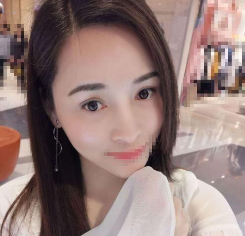 赤峰现代妇产医院医疗美容科袁俊龙双眼皮修复案例分享
