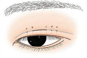 广西帝医医疗美容门诊部双眼皮的术后效果