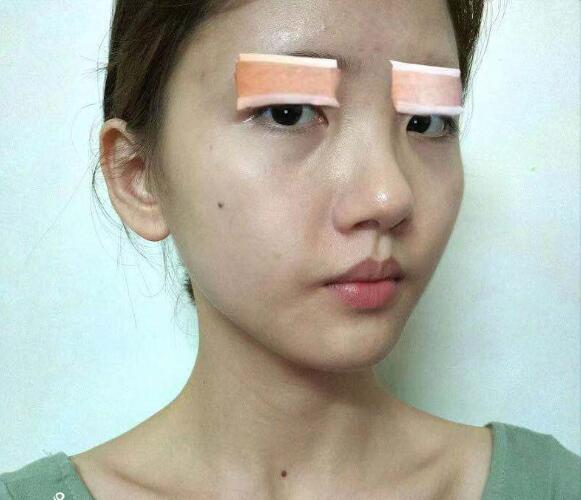 杭州同荣丽格医疗美容冯志丹全切双眼皮案例术后恢复效果对比图！