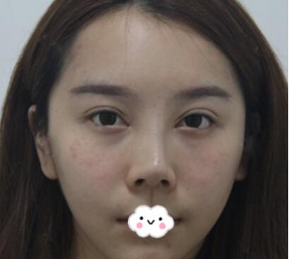 北京博士园整形医生郭以文假体隆鼻修复前后效果对比图