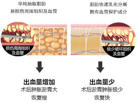 环形吸脂减肥手术原理介绍：