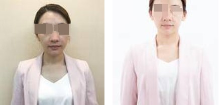 上海攸维医疗美容诊所整形医生李静做膨体隆鼻案例展示