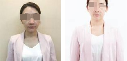 上海攸维医疗美容诊所整形医生李静做膨体隆鼻效果怎么样？附案例展示
