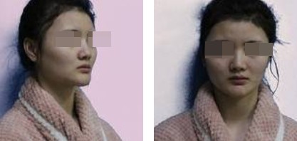 上海新健威医疗整形医生钱成宝做肋软骨隆鼻+自体脂肪全脸填充案例
