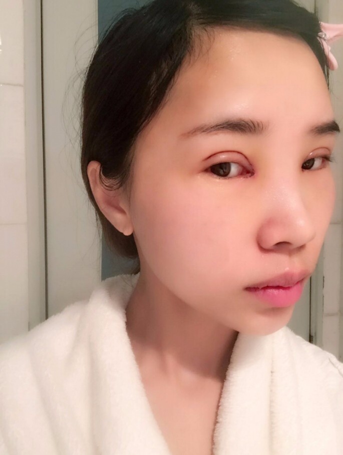 杨海平双眼皮手术案例