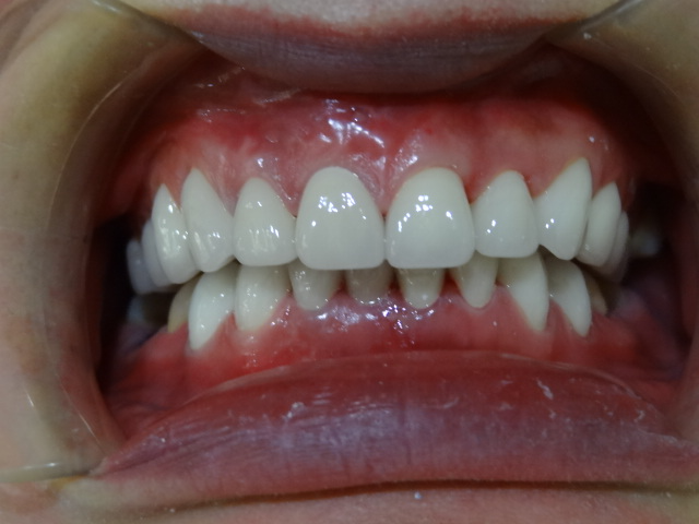 安徽天鹅湖口腔医院周健医生做超声波洗牙效果怎么样？附超声波洗牙效果案例