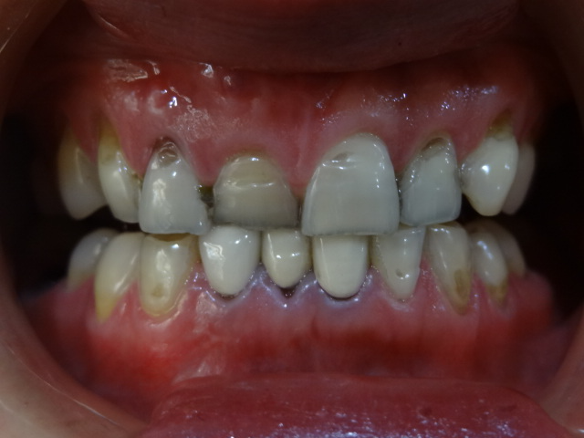安徽天鹅湖口腔医院周健医生做超声波洗牙效果怎么样？附超声波洗牙效果案例
