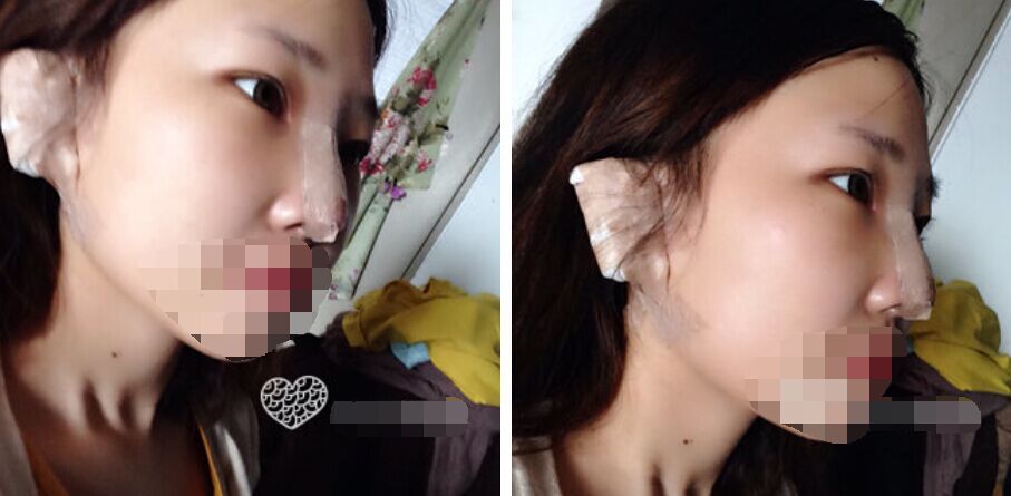 珠海艾瑞医疗美容医院余昌盛医生做耳软骨隆鼻真实案例分享