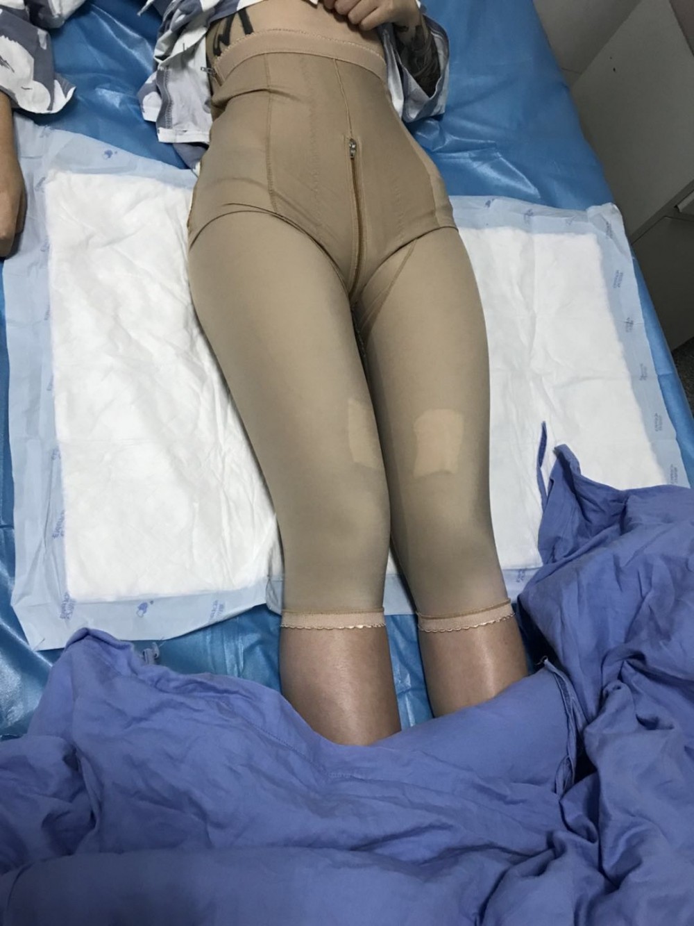深圳鹏爱医疗整形医生张建文做大腿吸脂怎么样？附大腿吸脂案例效果对比图