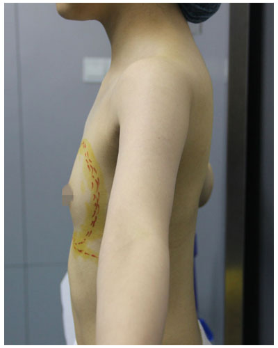 珠海韩妃医疗整形医生宋兆丹做假体隆胸案例效果对比图