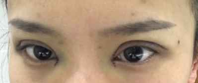 长春麦西美嘉整形医生王圣博做双眼皮手术效果怎么样？附双眼皮案例