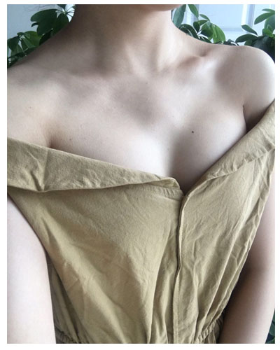 珠海韩妃医疗整形医生宋兆丹做假体隆胸案例效果对比图