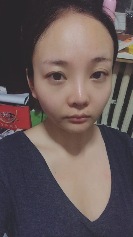 北京可思美医疗整形医生苏静做脸部自体脂肪填充效果怎么样？