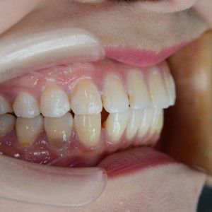 厦门拜博口腔医院医生张忠做牙齿隐形矫正怎么样？附案例效果对比图