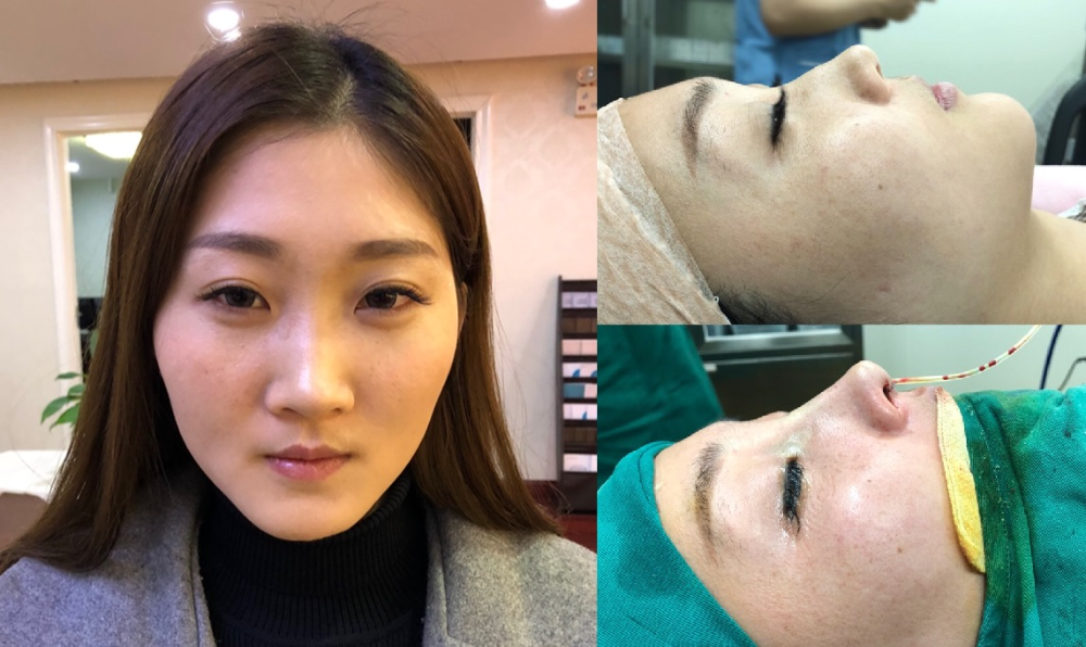 上海首尔丽格医疗美容医院医生朴晟秀做膨体隆鼻怎么样？附案例效果图