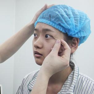 武汉伽美医疗美容医院医生郑泰成做切开双眼皮怎么样？附案例