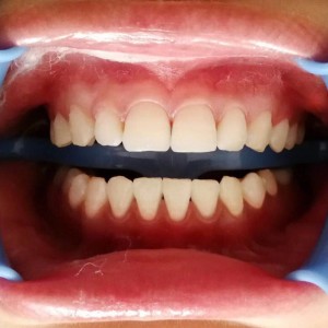 肇庆中大口腔医院医生伍雪红做牙齿冷光美白怎么样？附案例效果对比图