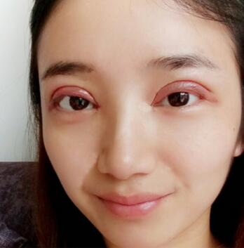 长治松禾医疗美容诊所医生马俊峰做韩式微创定点双眼皮效果怎么样？附案例
