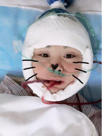 上海时光整形医生何晋龙做下颌角磨骨术前术后案例效果对比图