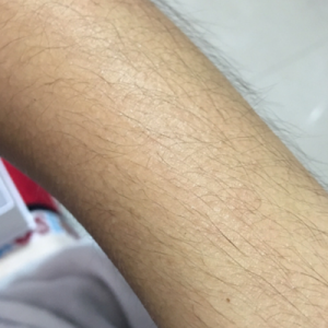蚌埠市第三人民医院烧伤整形科李勇医生做手臂激光脱毛案例效果图
