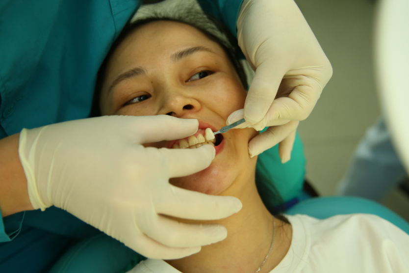 保定东阳口腔医院赵星医生做牙齿瓷贴面怎么样?附牙齿瓷贴面案例效果对比图