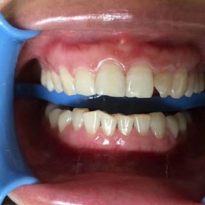 保定东阳口腔医院王增光医生做牙齿美白怎么样？附牙齿美白案例效果对比图
