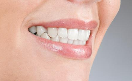 牙齿矫正大概需要多少钱？多少钱一颗？